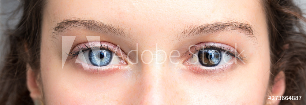 Ein Mensch, zwei Augenfarben (Heterochromie) – Wie kommt es dazu ?